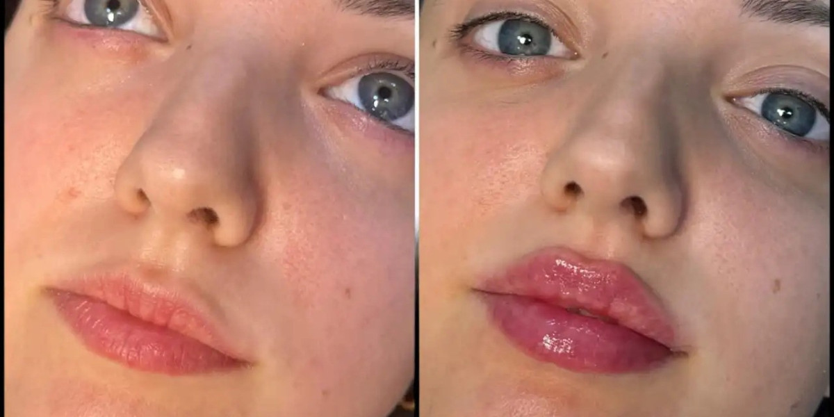 Best Plastic Surgeons in dubai Mastering Dermal Fillers?