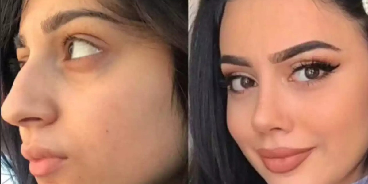 Can the Best Rhinoplasty Surgeon in Dubai Achieve Balanced Features?