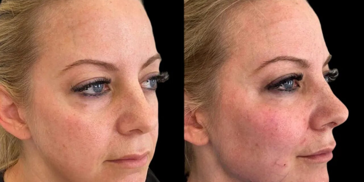 Cheek Fillers Results That Last Trust the Best Plastic Surgeons in Dubai