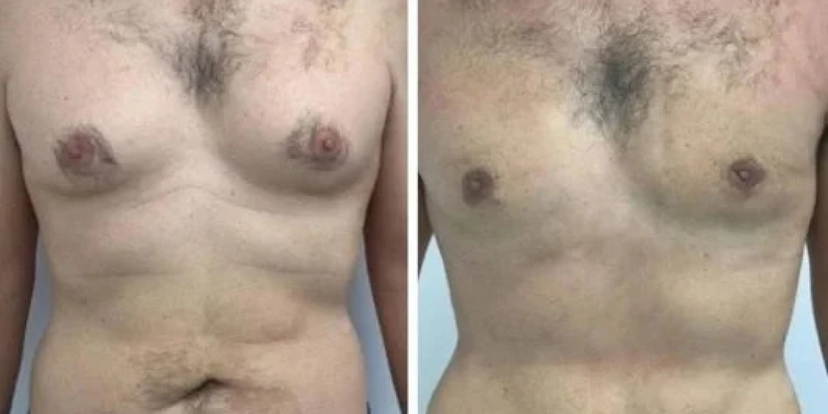Best Gynecomastia Surgeons in Dubai: Advanced Techniques for Better Results