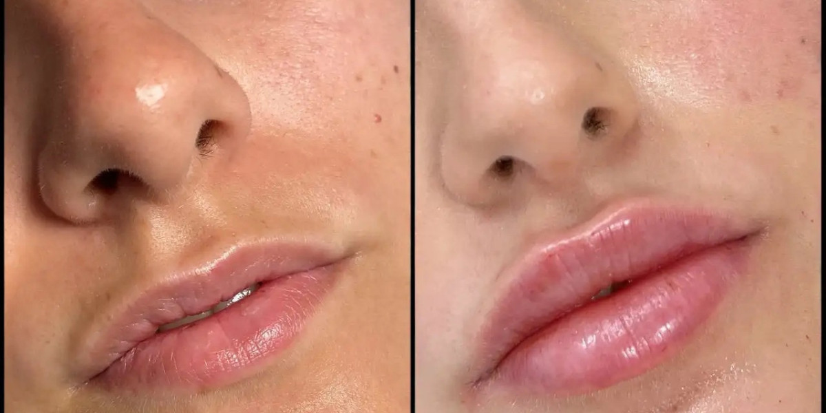 Best Plastic Surgeons in Dubai for Advanced Fillers Treatment