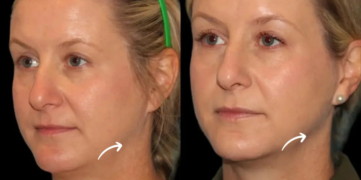 Sculptra in Dubai for Fine Lines on the Upper Chest