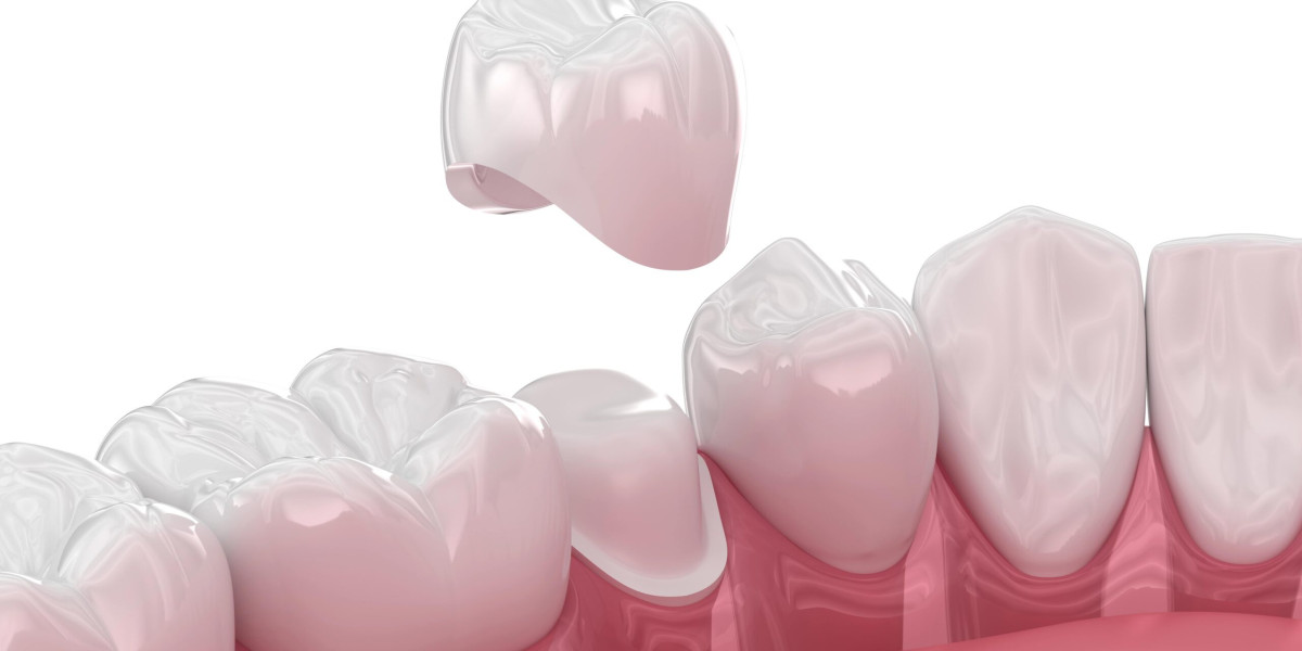 Tooth Crown Dubai: Understanding the Steps Involved in Crown Treatment