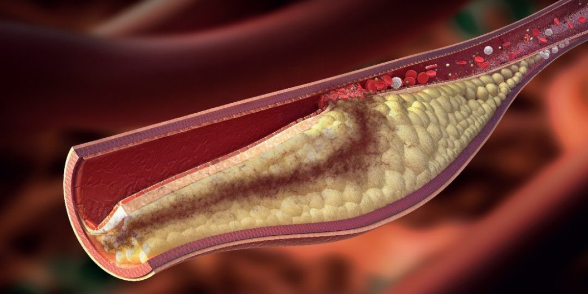 High Cholesterolemia Dubai: How Do Lifestyle Factors Affect Cholesterol?