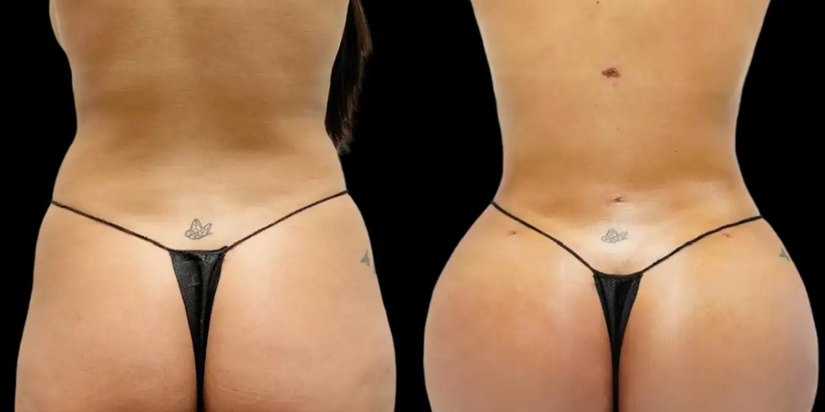 Fat Transfer in Dubai: Questions to Ask Your Plastic Surgeon