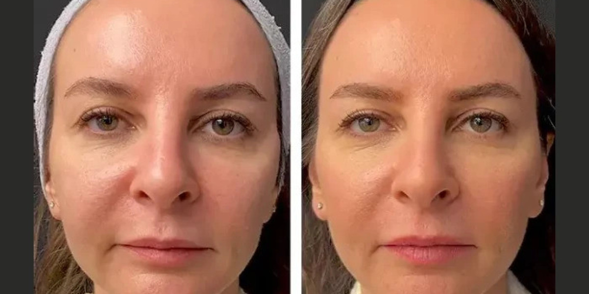 Best Doctors in dubai: Mesotherapy Dull & Tired-Looking Skin Treatment