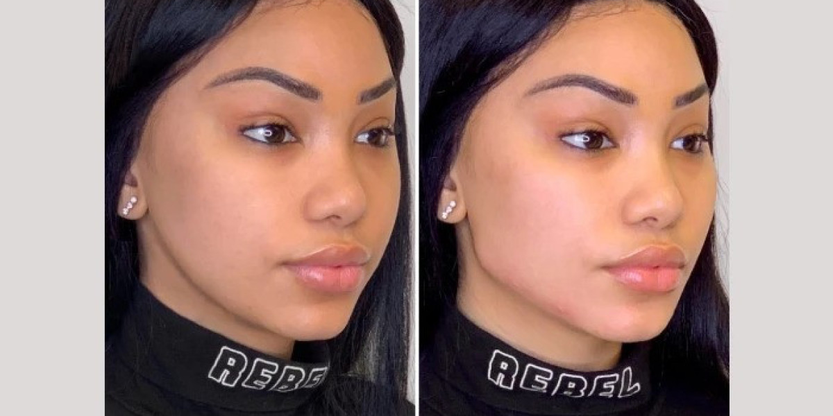 Thread Lift Treatments in Dubai: Advanced Anti-Aging Solutions for Contours