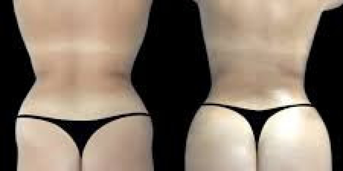 Butt Fat Transfer in Dubai: A Guide to Treatment Planning