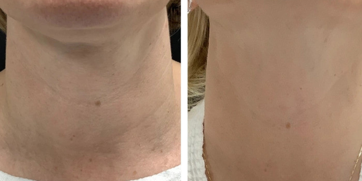 Radiofrequency (RF) Microneedling treatments in Dubai for Even Skin Texture