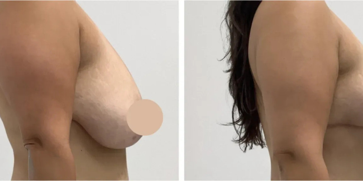 Best Breast Lift Surgeons in Dubai for Modern Aesthetic Breast Surgery