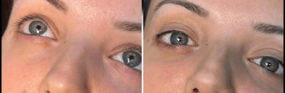dermal fillers Cover Image