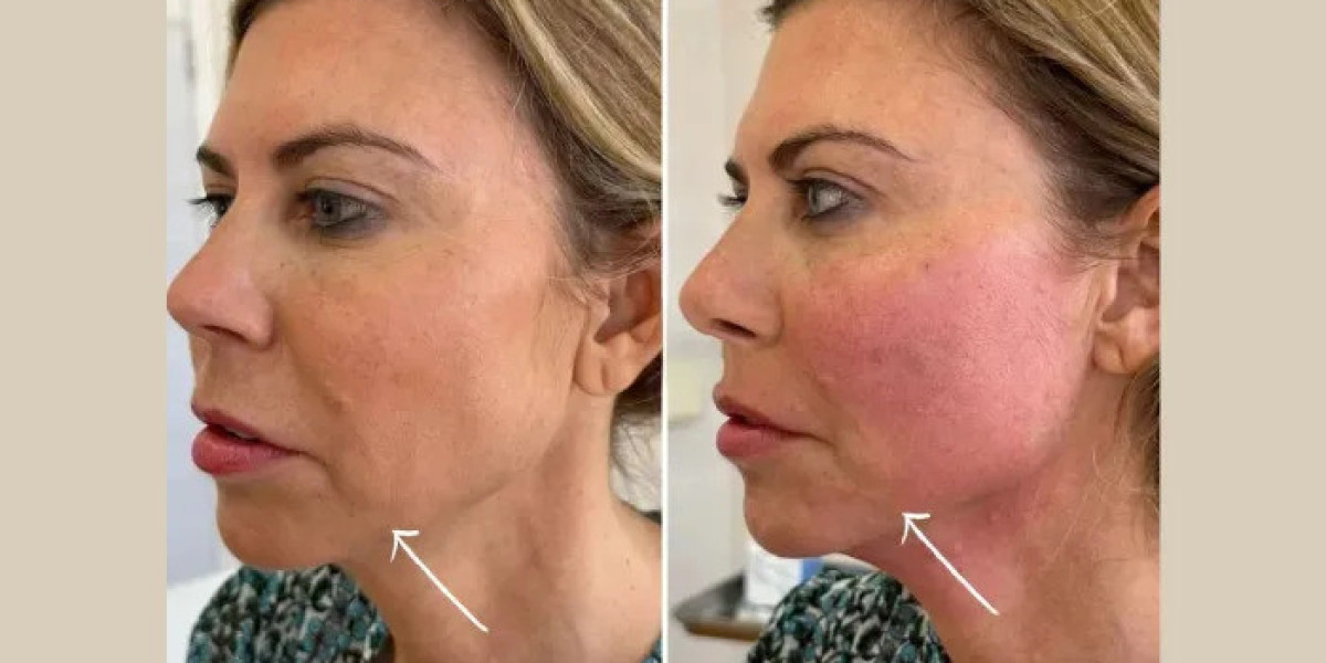 Endolift Treatments in Dubai for Personalized Skin Tightening Treatments