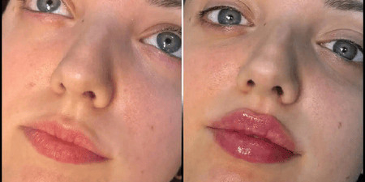 The Ultimate Beauty Trend: Fillers Treatments in Dubai Explained